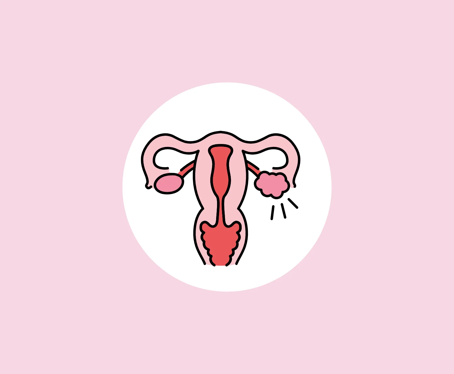 PCOS Management Services Hyderabad