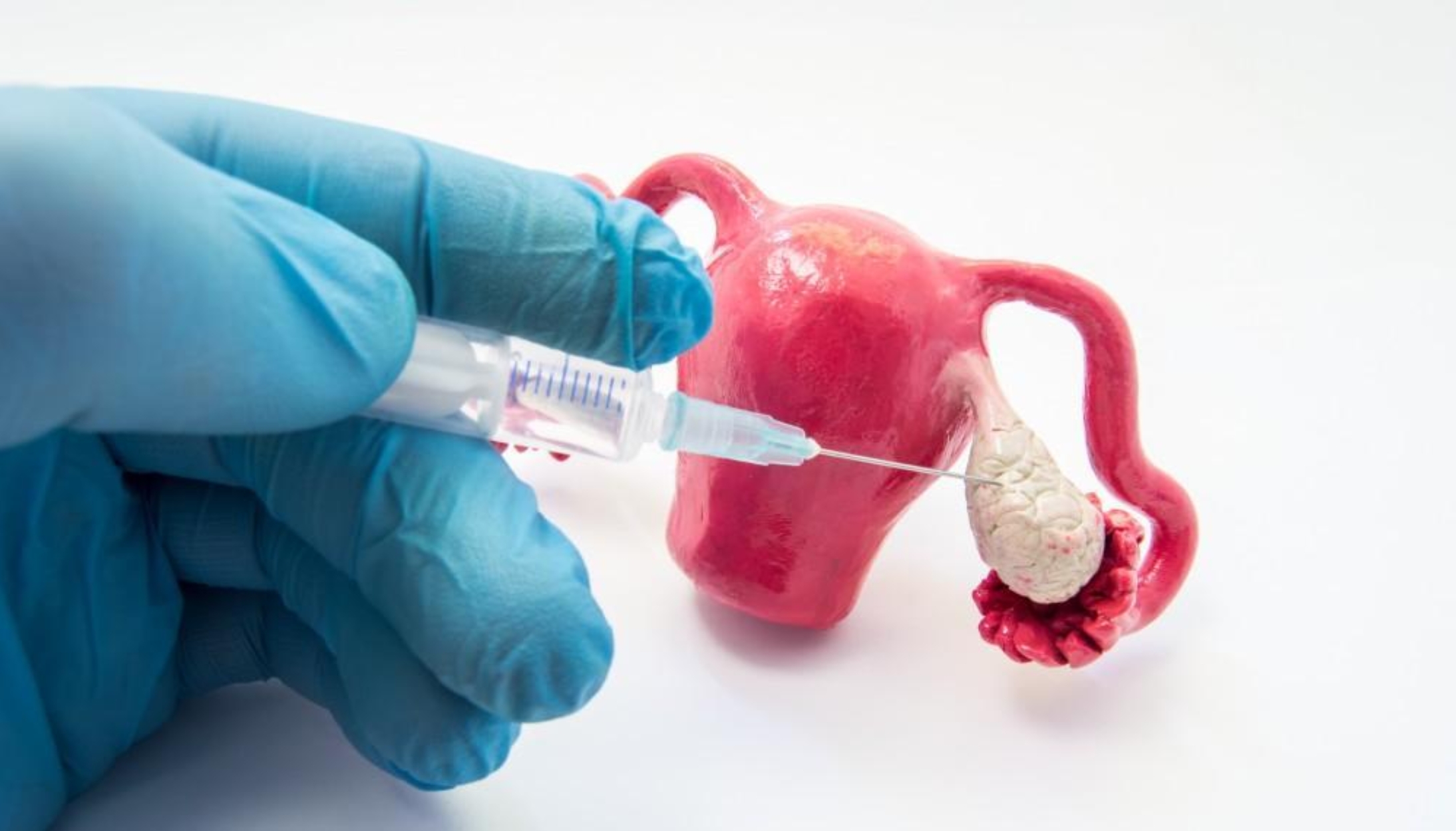 Ovulation Induction Treatment in Hyderabad | Gachibowli - Dr Sravya Buggana